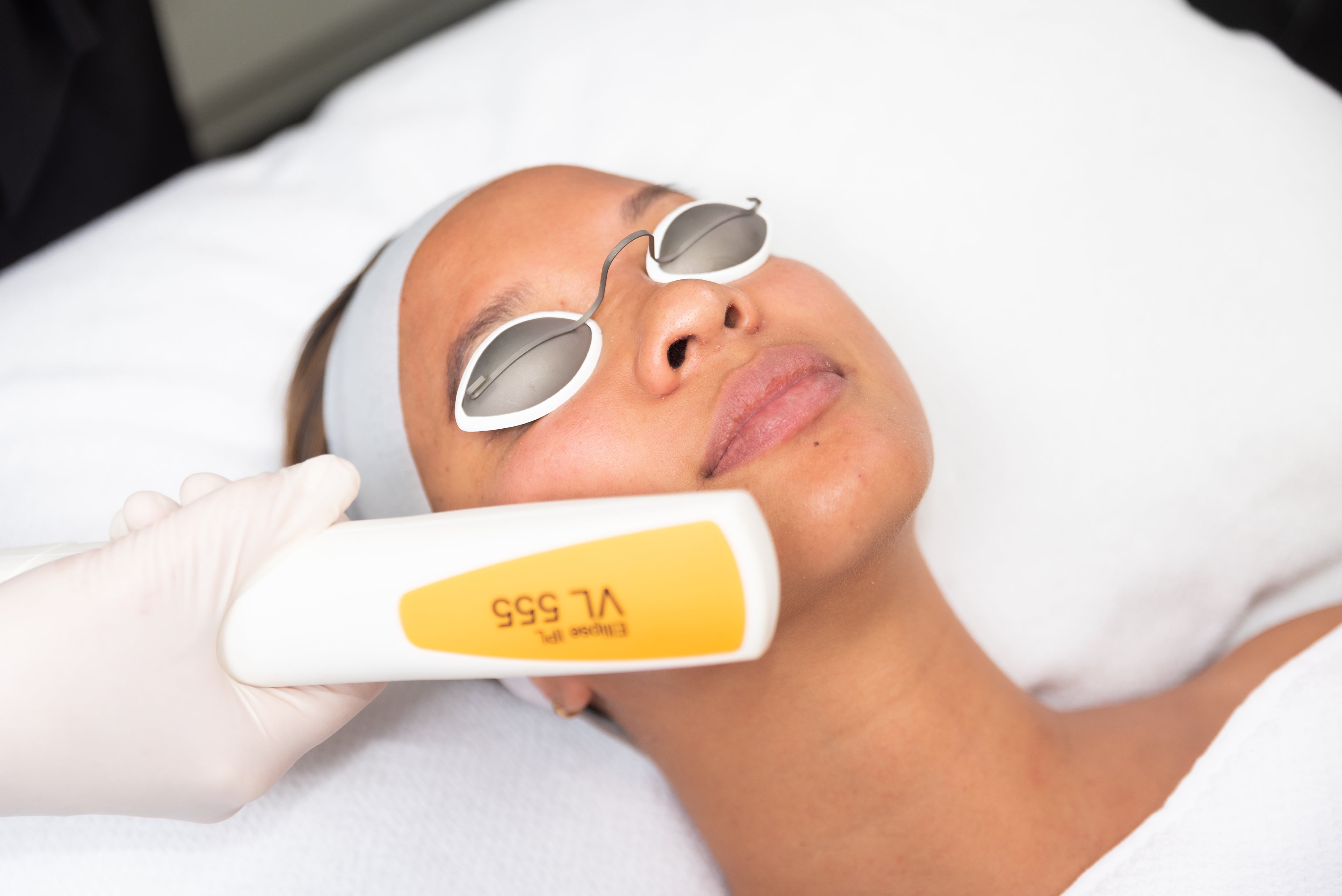 IPL vs. Laser for Treating Pigmentation The Clinic Bondi